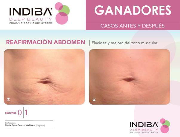 tratamiento abdomen Indiba